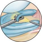 He or she will insert the arthroscope and use the image projected on the screen to guide it. If surgical treatment is needed, your surgeon will insert tiny instruments through another small incision.