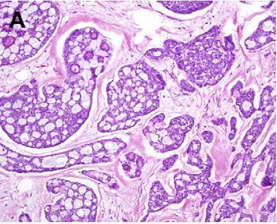 Adenoid Cystic Carcinoma Predominantly described in post-menopausal women Usually triple-negative phenotype, with low proliferation Metastases are rare, and have been reported to spread many years