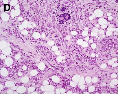 Pleomorphic Lobular Cancer Weigelt B,