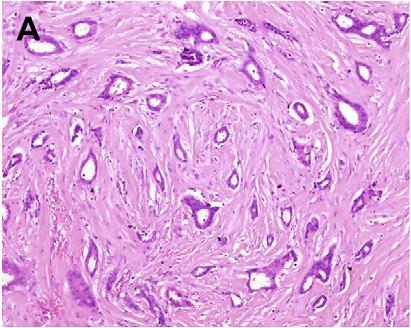 Tubular carcinoma Readily mammographically detectable (spiculate nature, associated cellular stroma) Clinical charachteristics: Older patients, small T size,