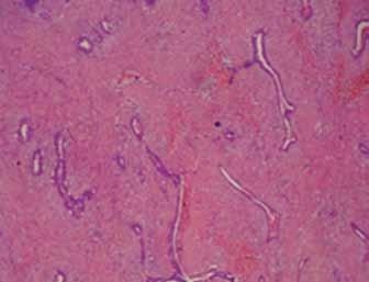 Figure 2B: Section showing proliferating ducts and stromal component. (HE stain, X20) malignant breast lesion.
