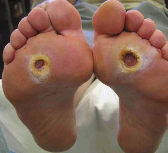 are spent on treating diabetic foot ulcers, and 85% of lower extremity amputations are preceded by a DFU.