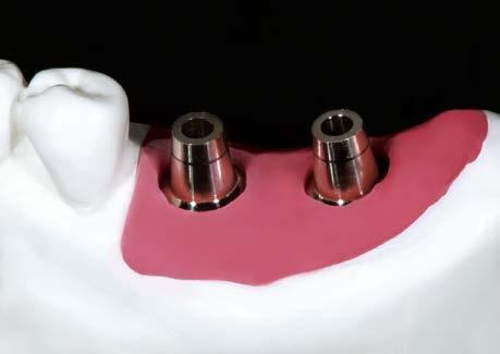Select abutment with proper
