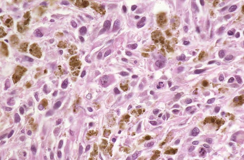 Intracellular accumulations. Macrophages containing melanin (brown pigment) in a malignant melanoma (medium-high power).