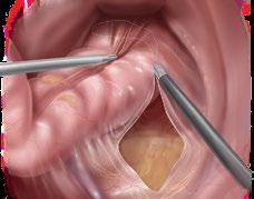 dissect the rectovaginal plane to the anal canal.