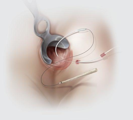 Anal fistula repair Using the Biodesign plug with no button The Biodesign Anal Fistula Plug Set is used for the repair of anorectal fistulas.