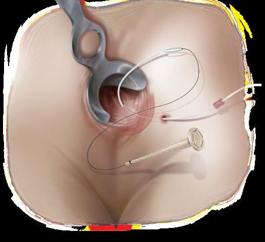 Anal fistula repair Using the Biodesign plug with the button The Biodesign Fistula Plug Set is used for the repair of rectovaginal and anorectal fistulas.