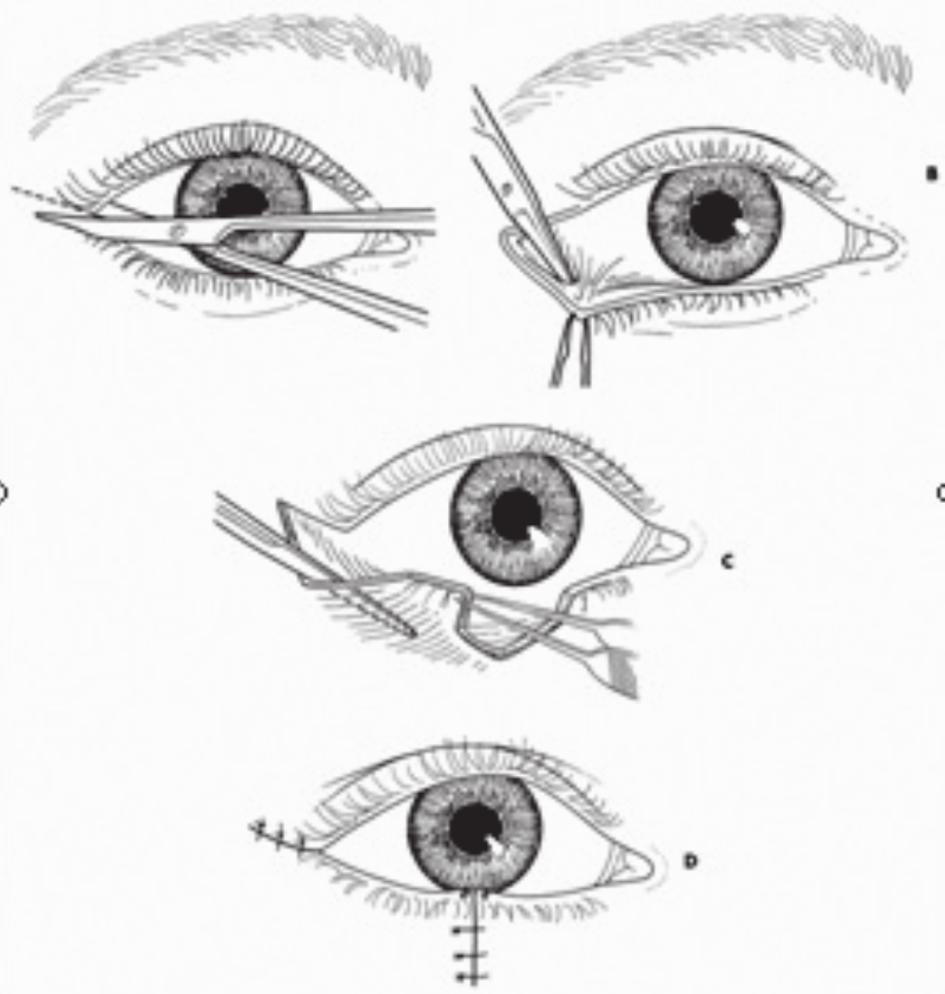 in less than 1/3 loss of tissue including the eyelid margin, the repair can generally be closed primarily.