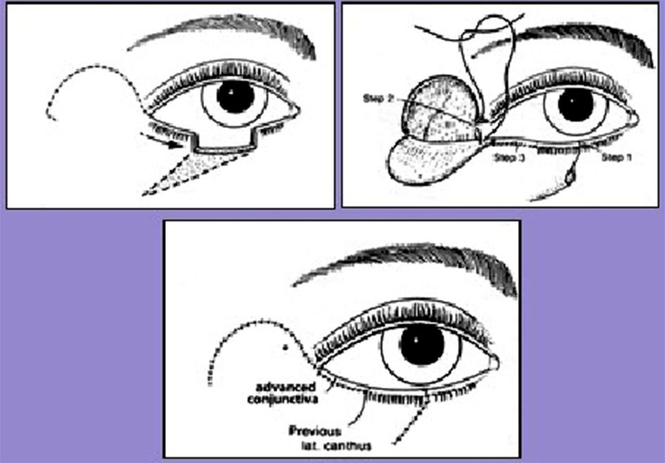 However, it is often necessary to freshen up the eyelid margins prior to reconstruction. Direct closure carried out as described for eyelid margin repair above (Figure 7).