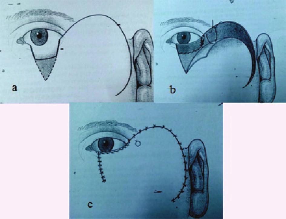In first stage, after measuring the upper eyelid defect, a three-sided inverted U shaped incision is marked on the lower eyelid, about 5 mm below lid margin.