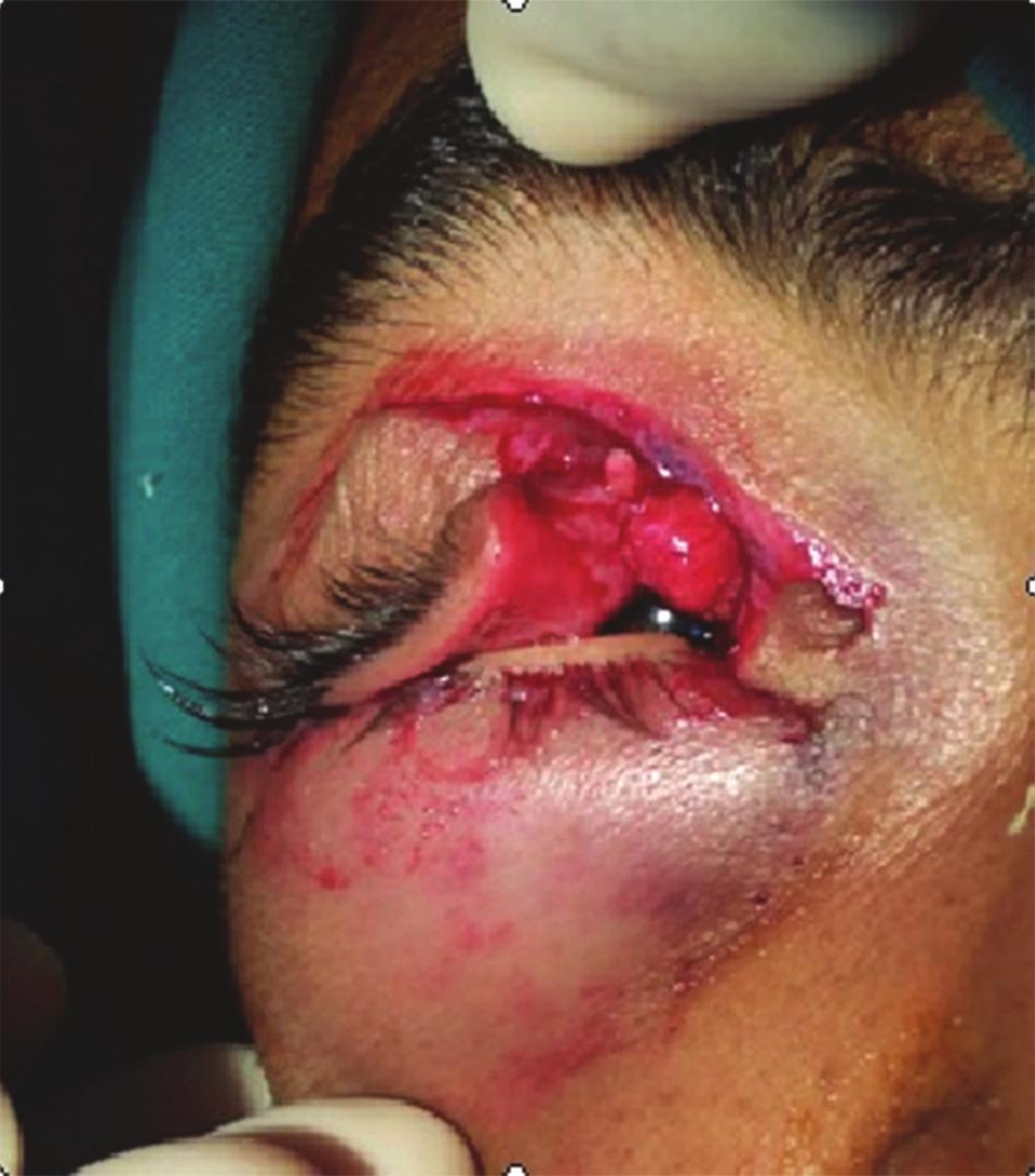 Ocular Trauma: Eye Lid Repair After identification of cut ends, canaliculus has to be stented using either monocanalicular (Minimonaka) or bicanalicular (Crawford) stents.