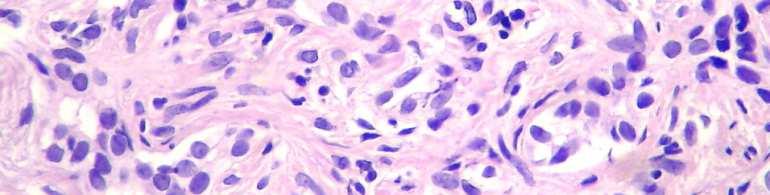 Liver biopsy in ATD steatosis: