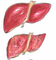 What is Hepatitis? Hepatitis means inflammation of the liver.