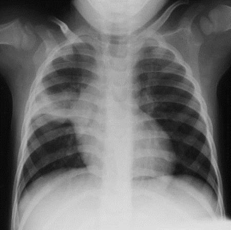 admit to hospital for further investigation If child well, review after 2-4 weeks *The clinical and CXR signs suggestive of TB are listed above If child does not fit definite criteria to start