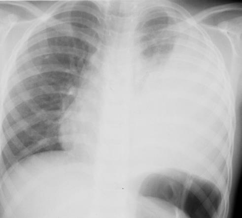 TB pleural effusion: large left-sided