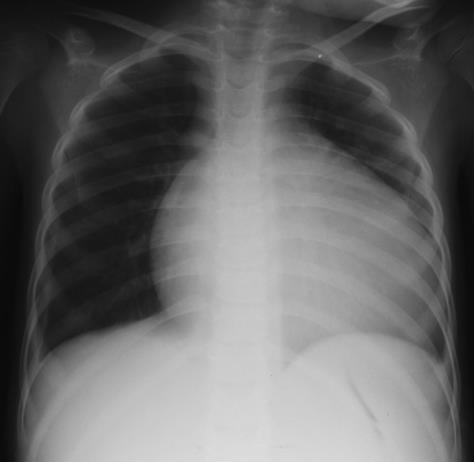 TB: collapse of thoracic vertebra causing