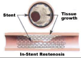 Endovascular brachytherapy (EVBT) EVBT: intraluminal delivery of radiation Stent Tissue growth g-emitter ( 192 Iridium) In-stent restenosis attenuation of