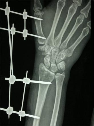 Several methods have been described in the literature for treatment of this rare fracture, from conservative treatment in plaster to open reduction and internal fixation.