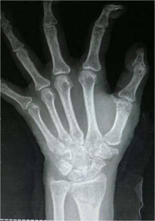 At a 6 month follow-up, radiographs showed normal articular relationship of the trapezium with the base of first metacarpal and scaphoid(fig 5, 6).
