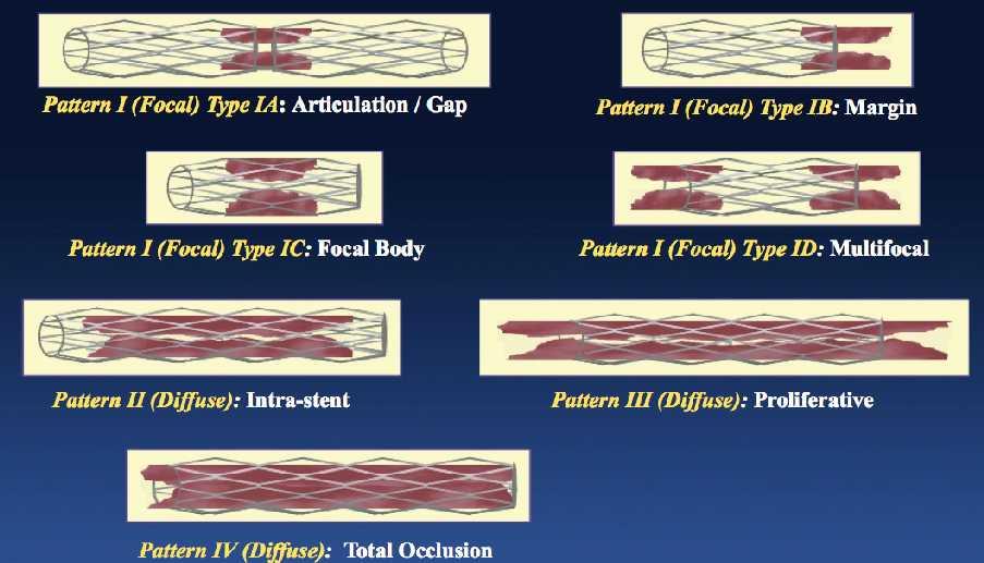 In-Stent Restenosis Angiographic