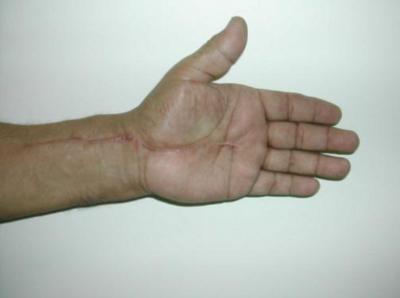 The patient was discharged after a week of treatment, and started hand