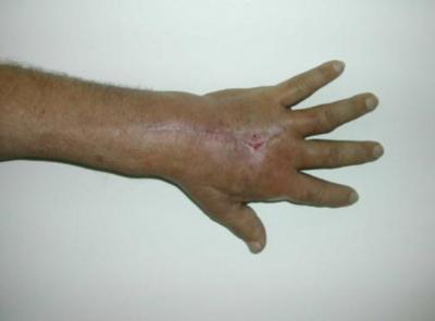 Figure 7 Figure 8 These injuries occur usually over the dorsal aspect of the fingers or the MCP joints, an area which is susceptible to deep infection, because the thin layer of skin overlaying.