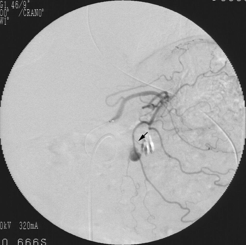 J Korean Radiol Soc 2007;56:33-39 (Table 1). Coils were used along with in a patient with gastric ulcer bleeding because of the trouble with selecting the feeding artery (Fig. 2).