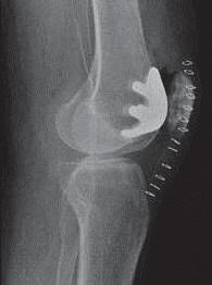 started April Post-operative X-rays - Patellofemoral MAKO in