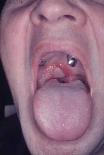 Aphthous Ulcer II. Periadenitis necrotica recurrent mucosae oris (Sutton.