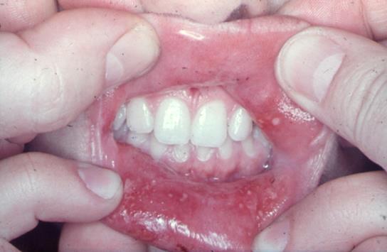 Aphthous Ulcer III. Herpetiform ulcer (Cooke.