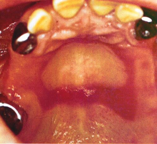 inflammation where the denture cover the palatal area.