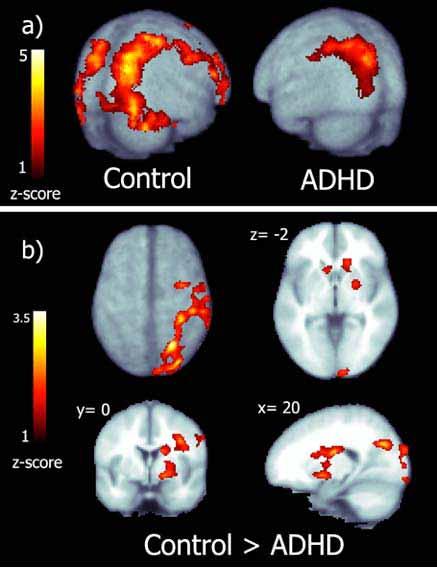 Region of activation BA C (mm) Z Control Group greater than ADHD-CT Group Parieto-Occipital R Precuneus 19 24-70 32 3.53 R Cuneus 19 32-90 28 2.