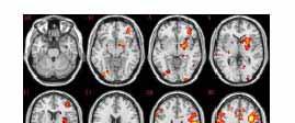 Region of activation BA C (mm) size Control group greater than OCD