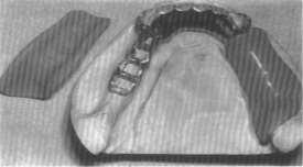 They described a technique that allowed the removable partial denture framework try-in and the impression for the altered cast to be efficiently completed in a single appointment.