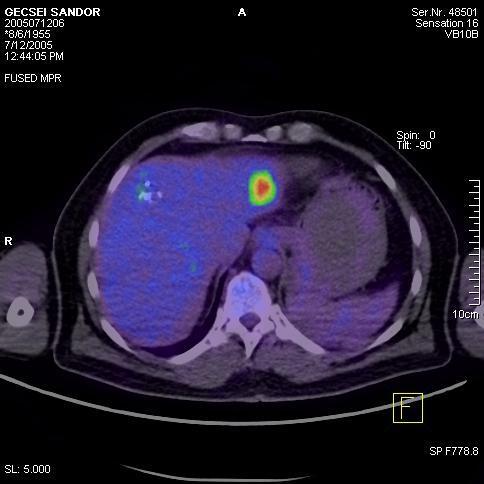 Liver metastasis of rectal cancer by 18F-FDG PET/CT