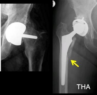 Interactive problems between bone structures and metal implants have also been investigated by CT-FEA since such problems are strongly related to mismatching of elastic modulus between the material