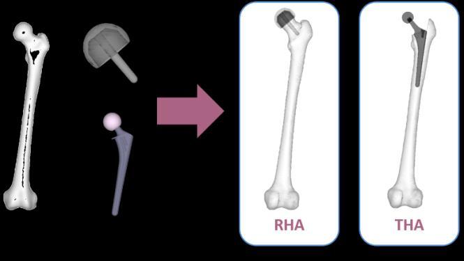 In order to analyse bone fracture associated with hip arthroplasties, a whole femoral model was also developed from CT images of a 54 years old male.