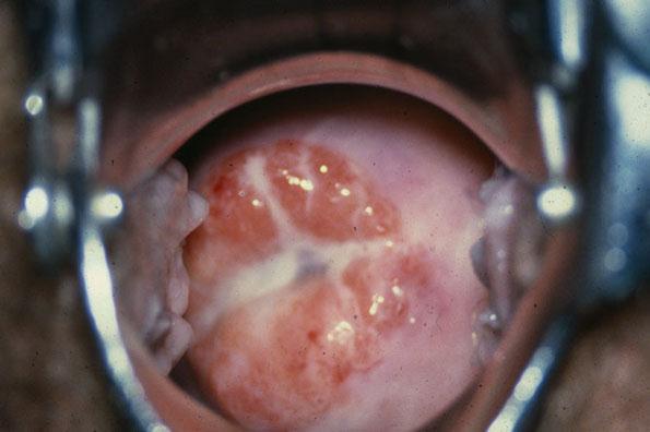 Cervicitis and Urethritis