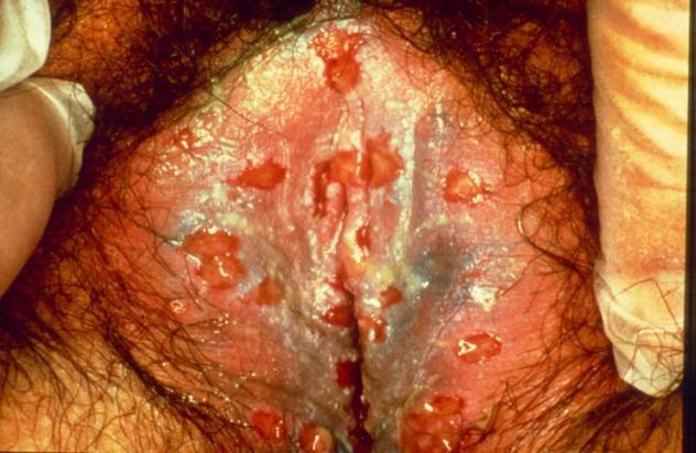 Case #5 19-year-old woman, 2-day history of painful ulcers in the vulvar area.