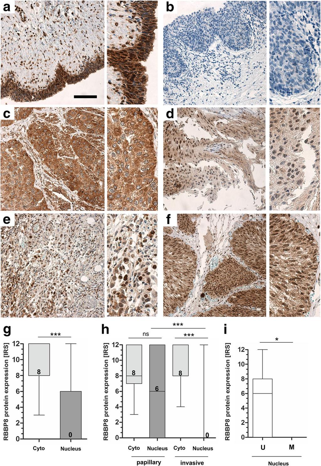 Mijnes et al. Clinical Epigenetics (2018) 10:15 Page 9 of 20 Fig. 5 RBBP8 protein loss in nuclei of bladder tumors. Immunohistochemical RBBP8 protein staining of representative tissues are shown.