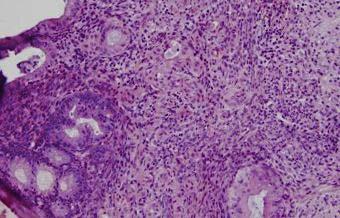 Ovarian Epithelial Tumors: Histological