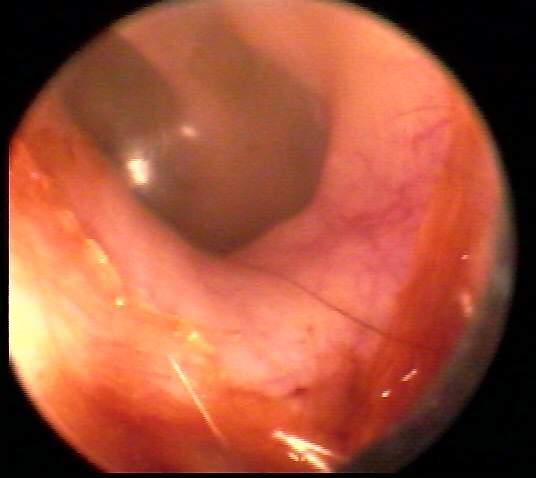 Normal Ear Canal and Tympanic