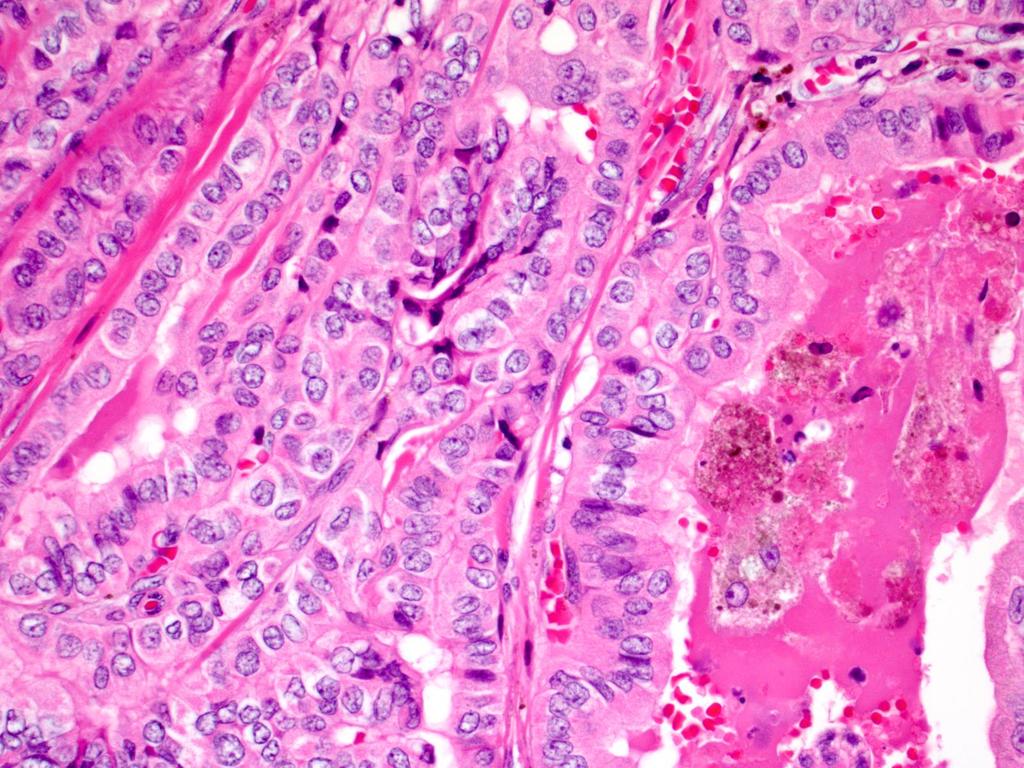 Prominent tall cells with hemosiderin