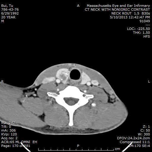 Medial abuttment of the lesion at