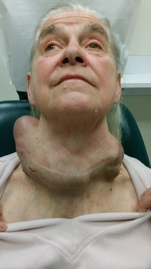 Physical Examination Well developed, well nourished female Neck Bilateral massive neck masses?