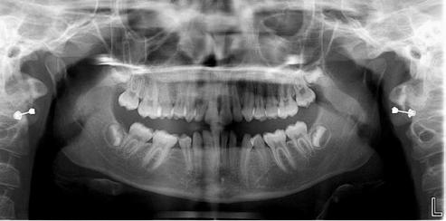 crowding (Figure 2). Full orthodontic records were completed with a Phase I case presentation.