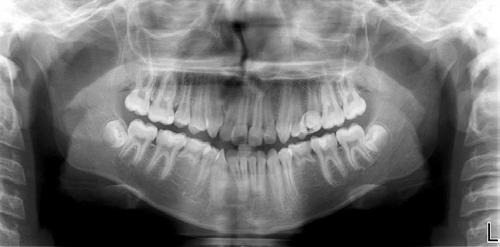 time, and his panorex (Figure 9) revealed congenitally missing mandibular second premolars and maxillary third molars. This is the most favorable combination of missing teeth for space closure.