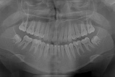 Case 3 This patient presented at age 11 years 4 months of age with a full cusp Class II Division 2 malocclusion, incisal crowding, maxillary constriction, and congenitally missing mandibular second