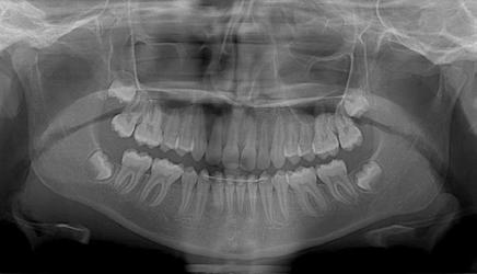 CONTINUING EDUCATION Figure 17: Case III pretreatment panorex shows congenitally missing mandibular second premolars Figure 16: Case III pretreatment photographs reveals a Class II Division 2
