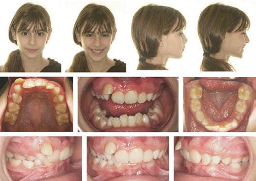 photographs shows favorable dental and facial changes since the initial presentation Conclusions Congenitally missing mandibular second premolars are a common problem.